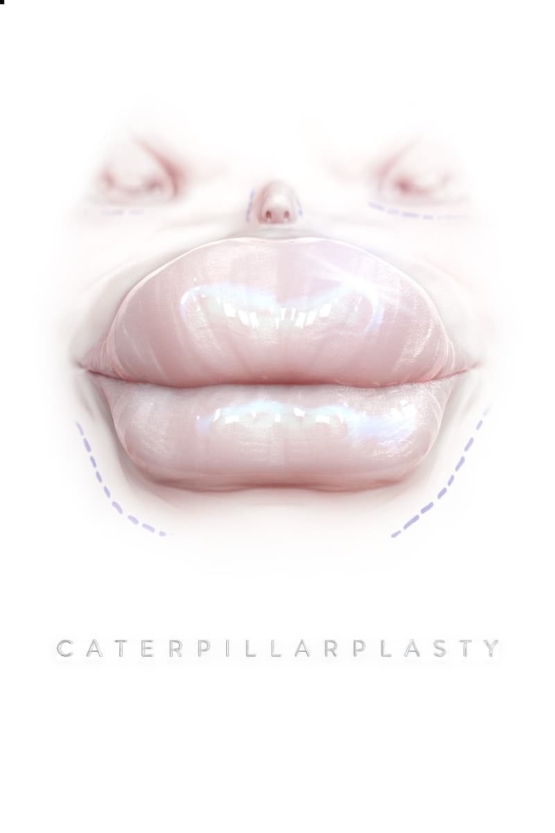 Caterpillarplasty