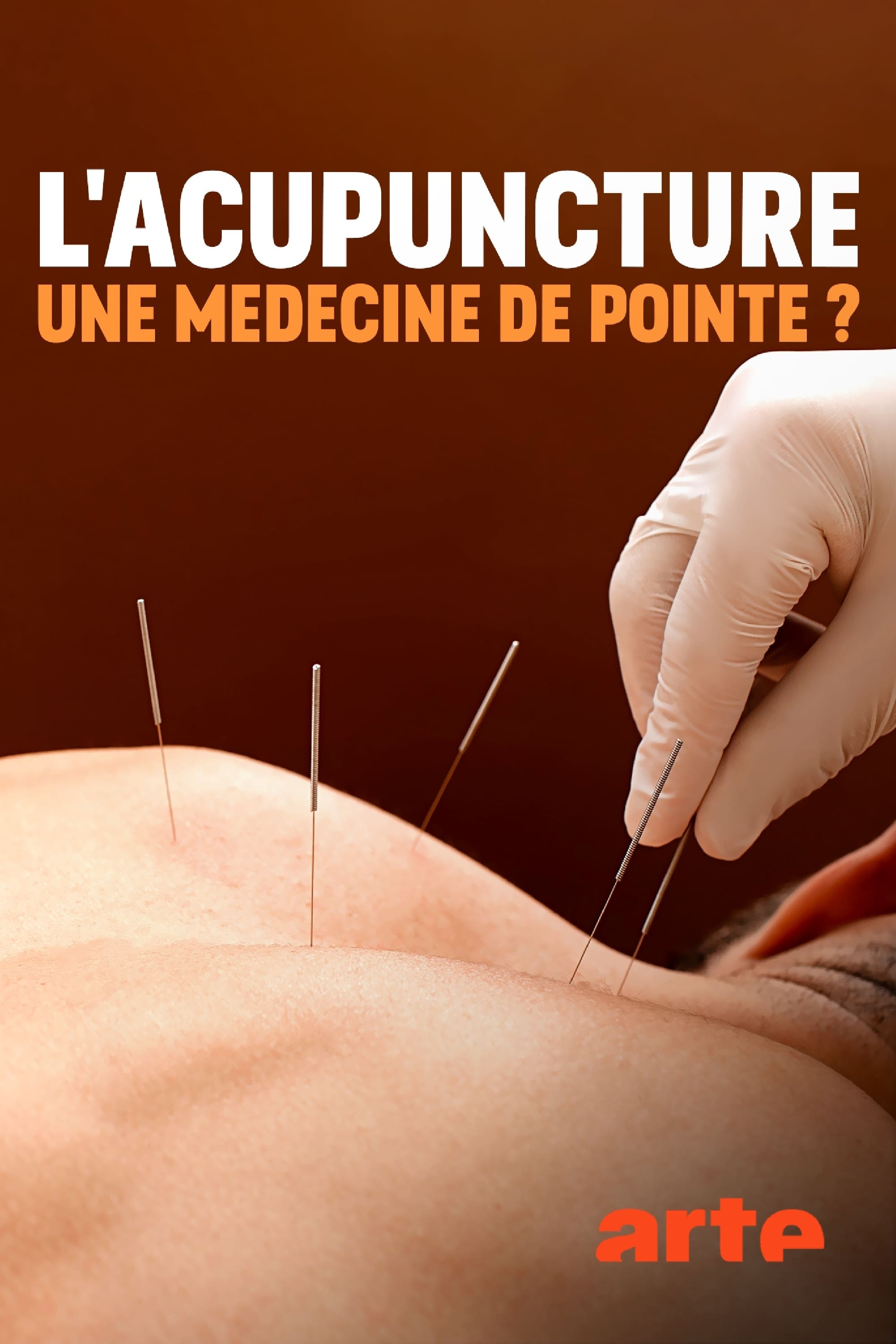Spitzenmedizin: Akupunktur - Mythos oder Therapie?