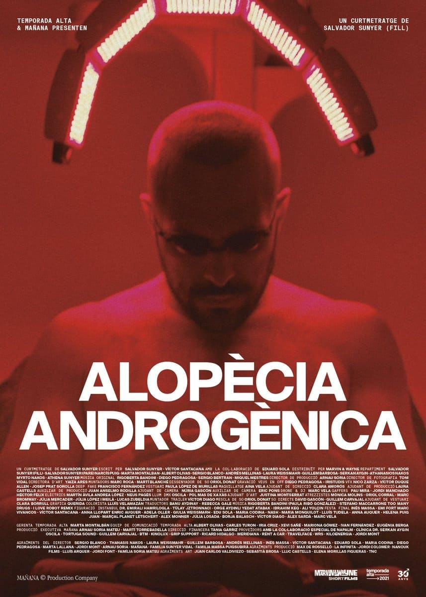 Androgenic Alopecia